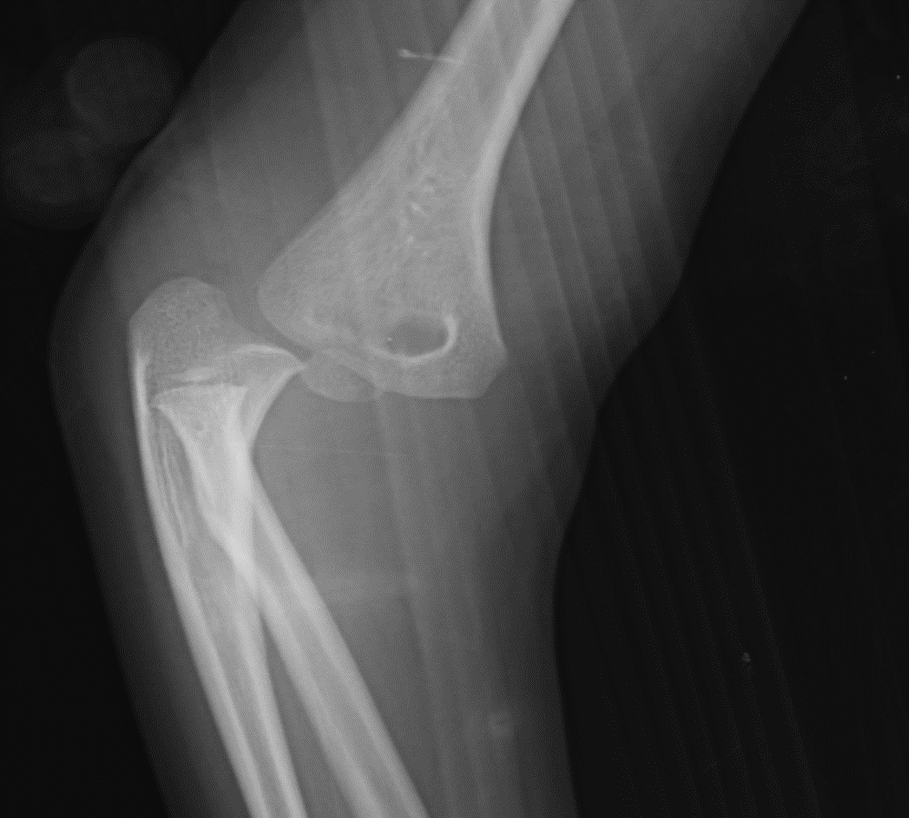 <p>Elbow Fracture on Lateral Radiograph. Posterior dislocation is visualized. </p>