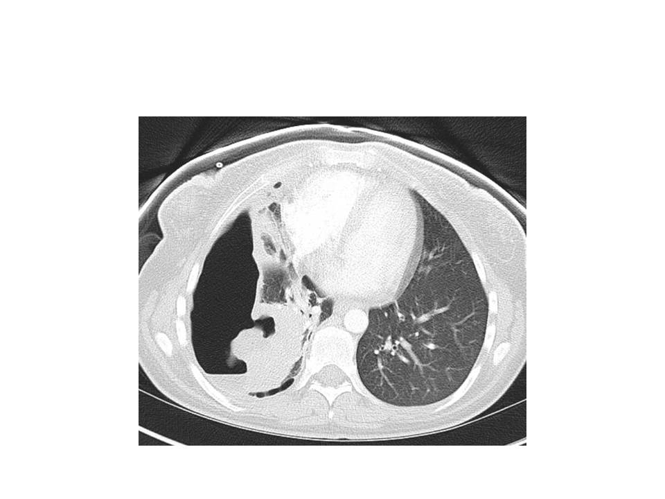 CT chest with contrast showing large right sided cavitary lung lesion with hydropneumothorax and collapsed lung in an AIDS patient due to Rhodococcus equi