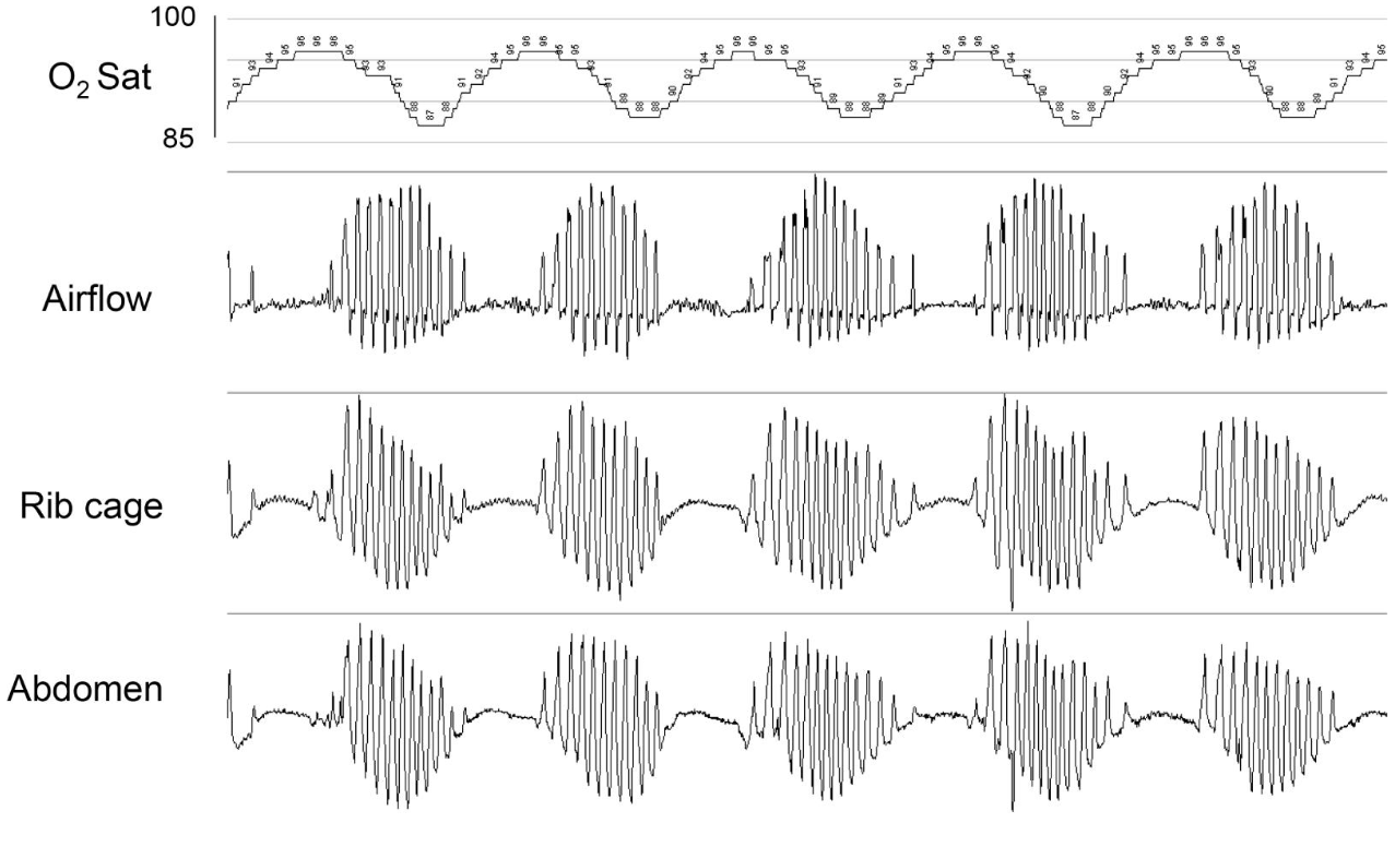 Graphical representation of  cheyne strokes respiration during polysomnography tracing showing cyclical periods of apnea and crescendo-decrescendo hyperventilation