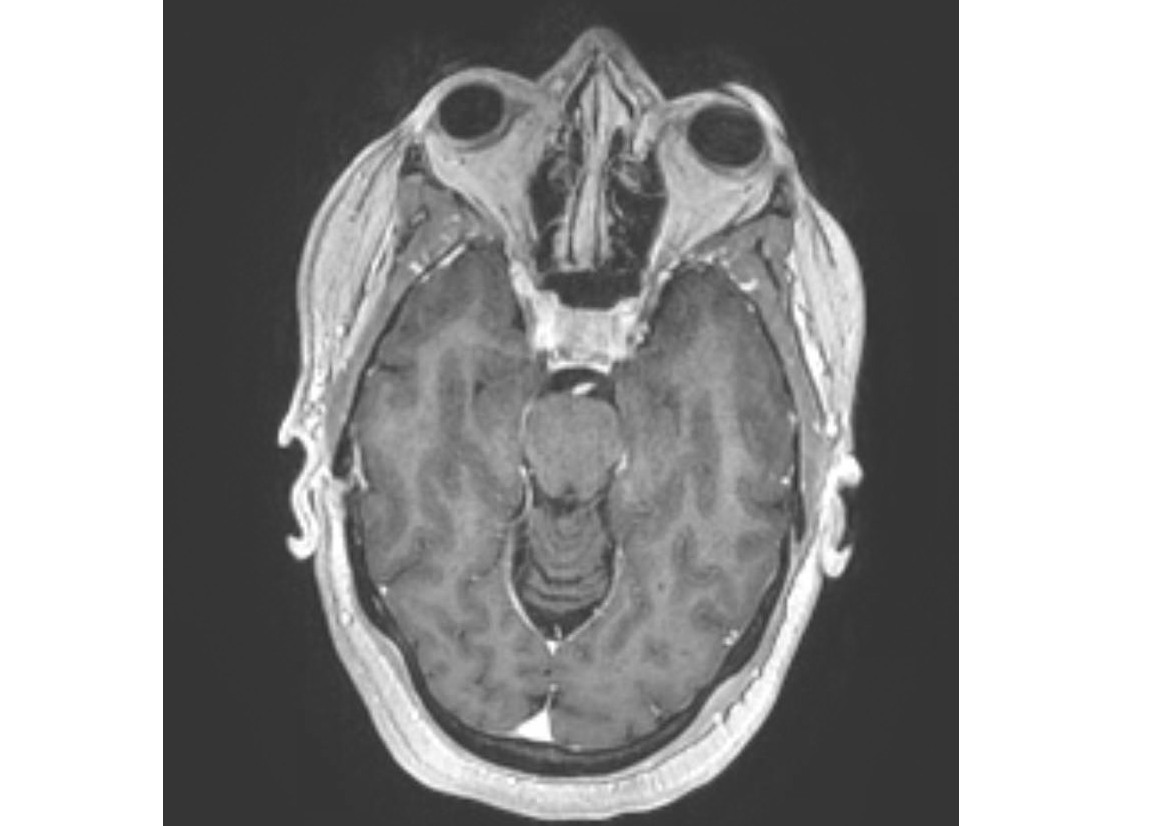 Axial FSPGR sequence with contrast on MRI in Tolosa-Hunt Syndrome