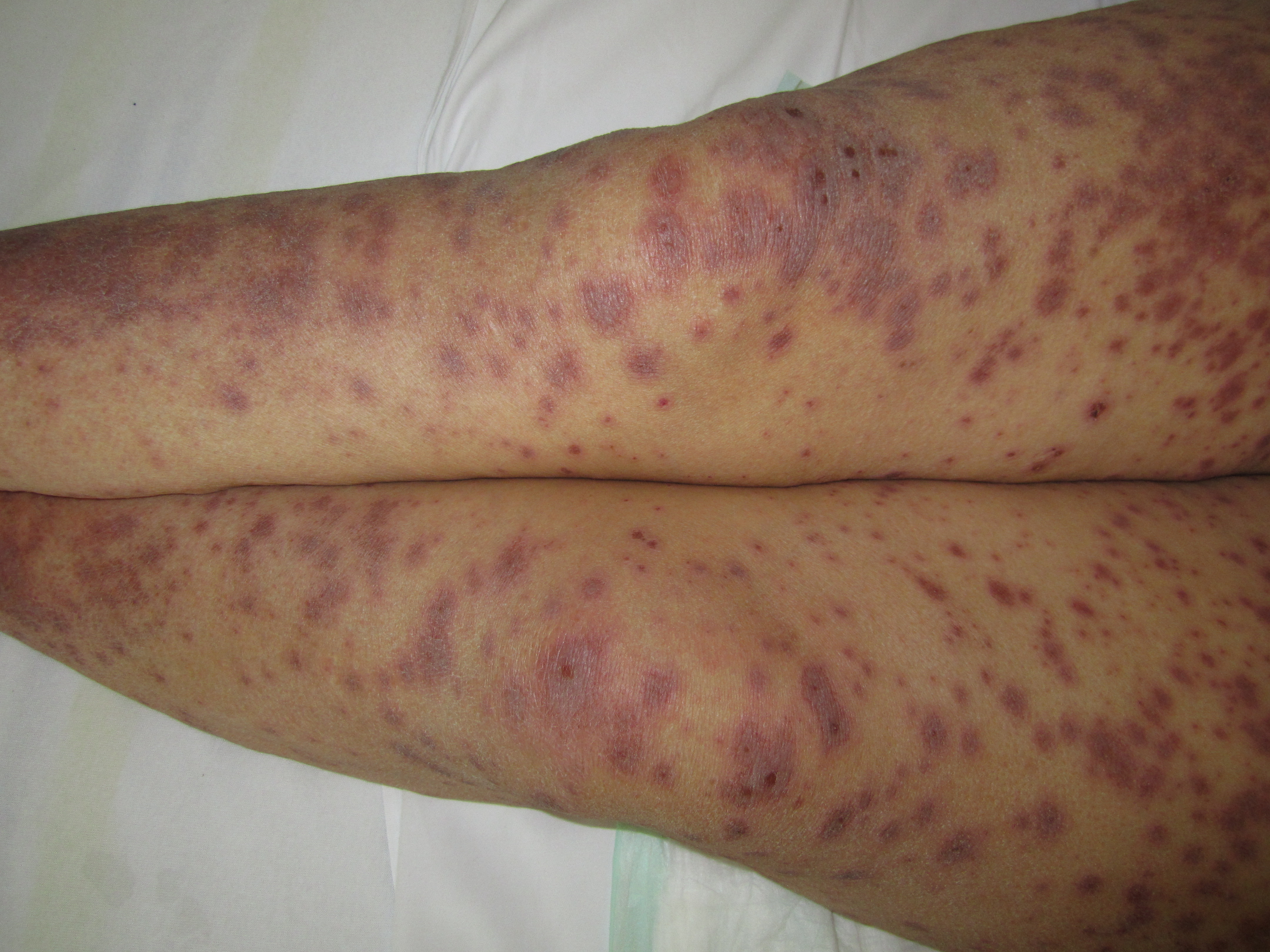 <p>Erythematous, Purpuric, Macules, targetoid lesions, Stevens Johnson Syndrome</p>