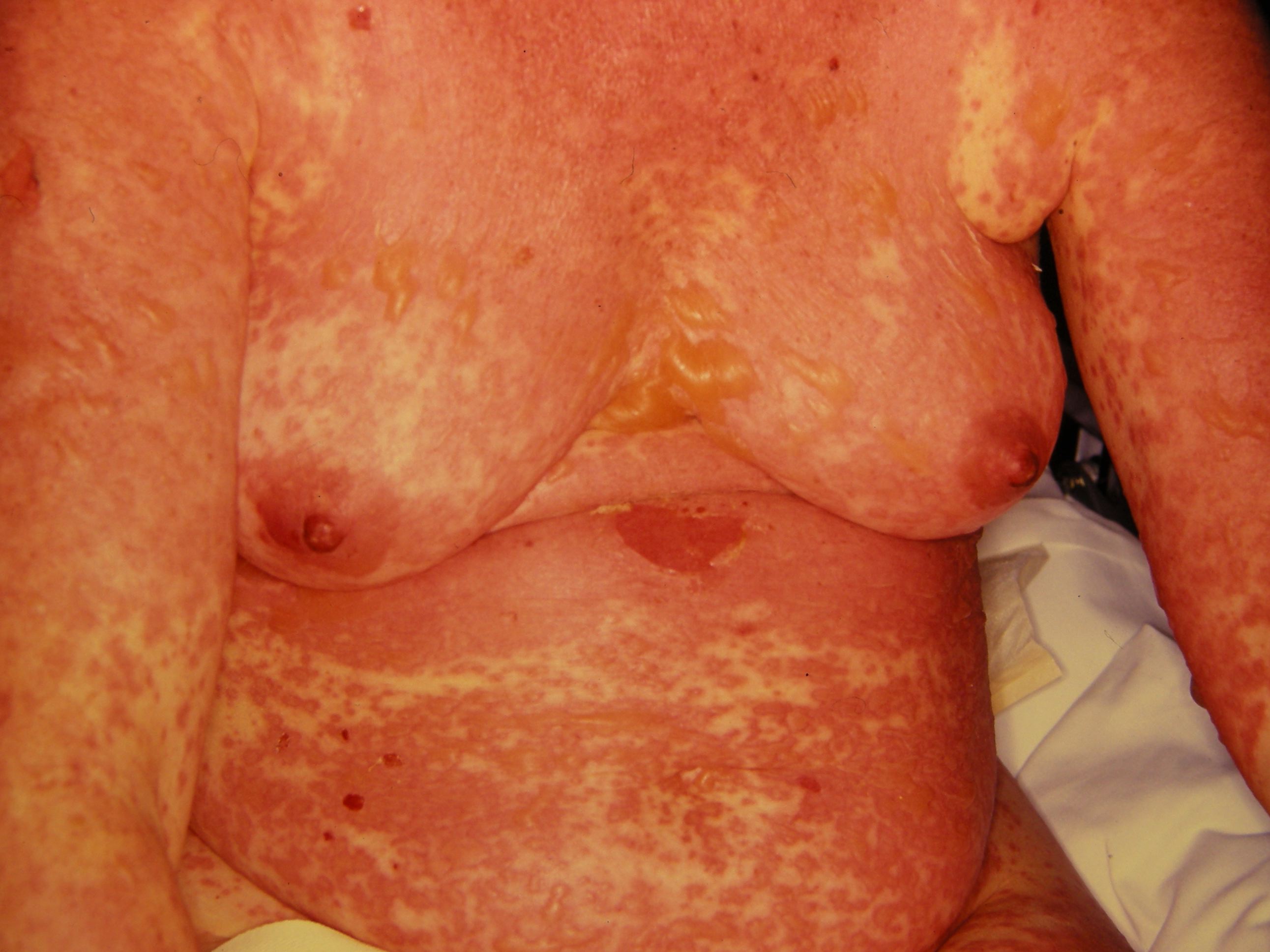 <p>Widespread early morbilliform eruption with flaccid bullae in patient with toxic epidermal necrolysis</p>