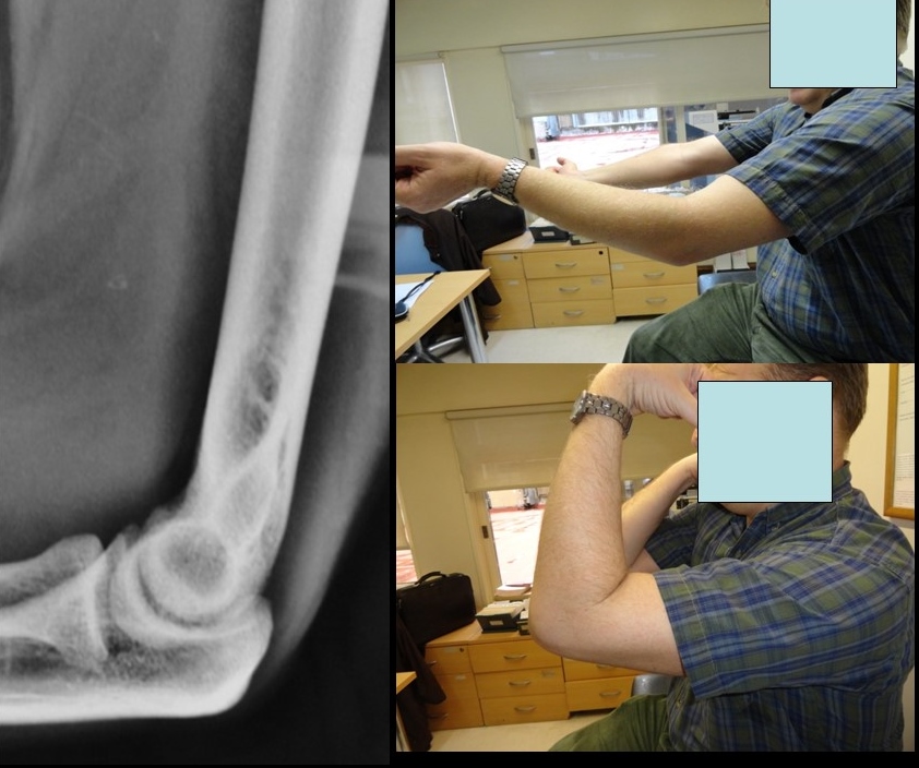 <p>Imaging Compared to Simple Dislocation. Simple dislocation is visualized on imaging.</p>