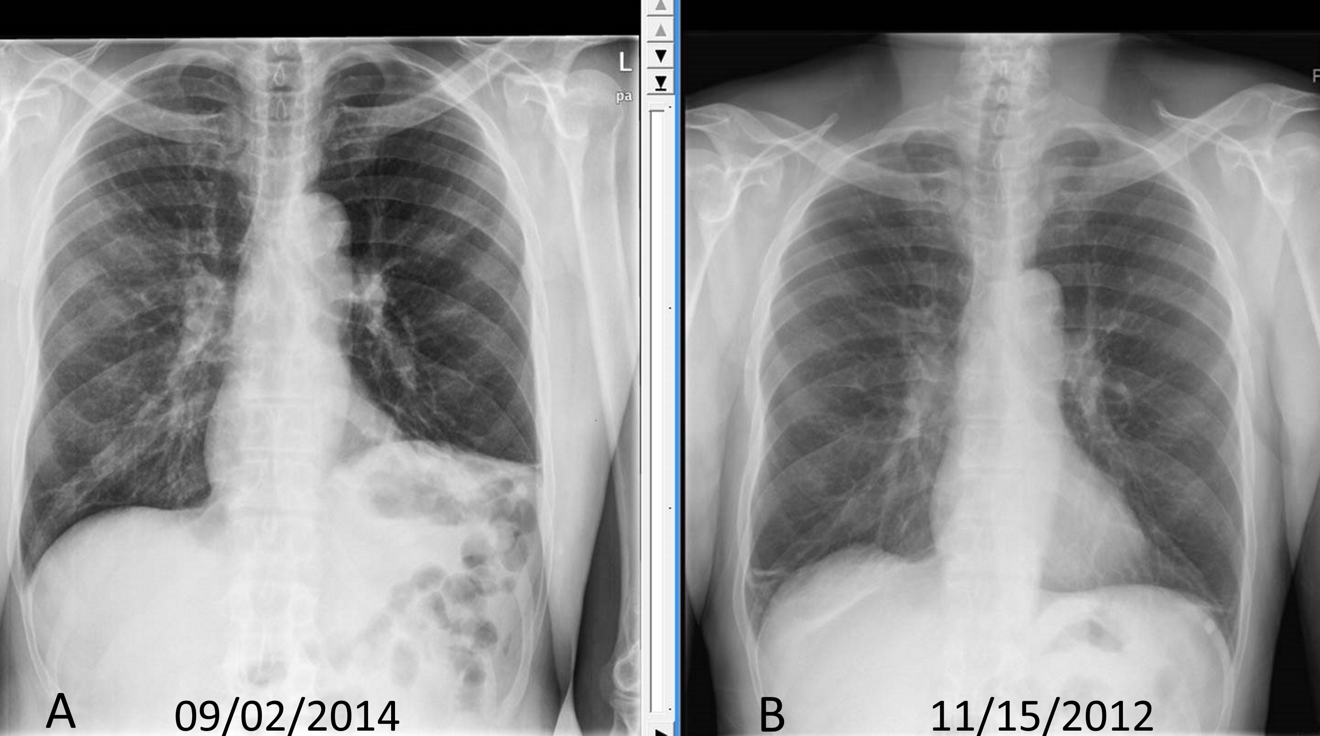 Chest x ray showing elevated diaphragm compared to chest x ray done two years back