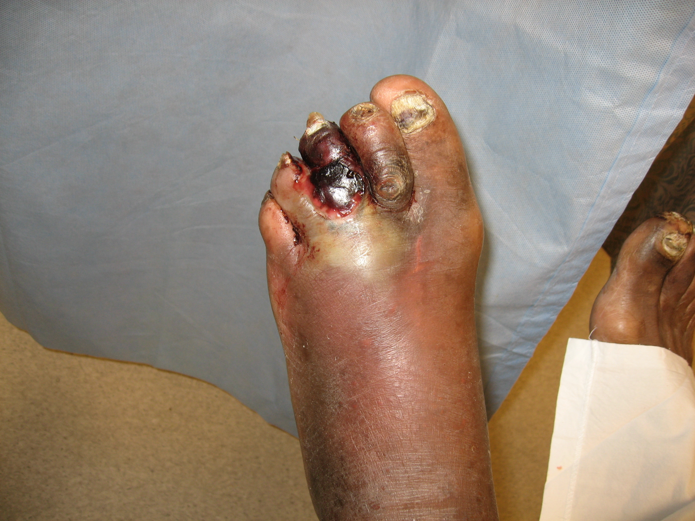 <p>Gas Gangrene of a Diabetic Foot</p>