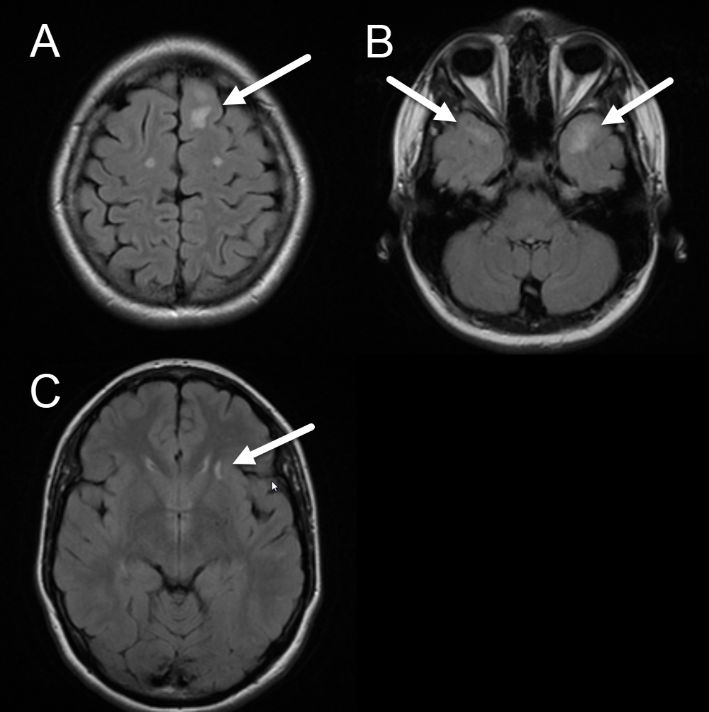 <p>Axial FLAIR Image, Cerebral Autosomal Dominant Ateriopathy