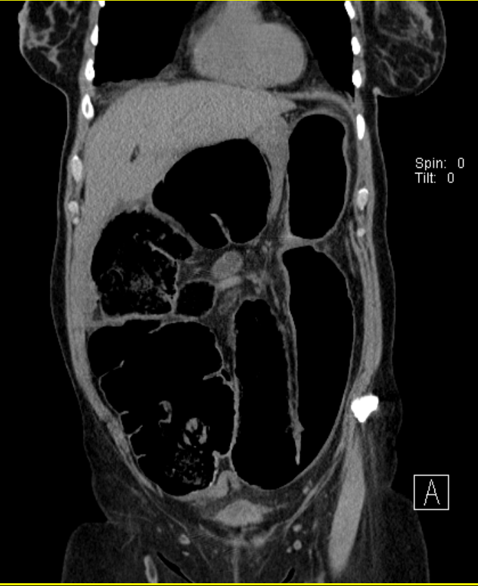 FIGURE 5: Coronal CT abdomen reveals cecal volvulus
