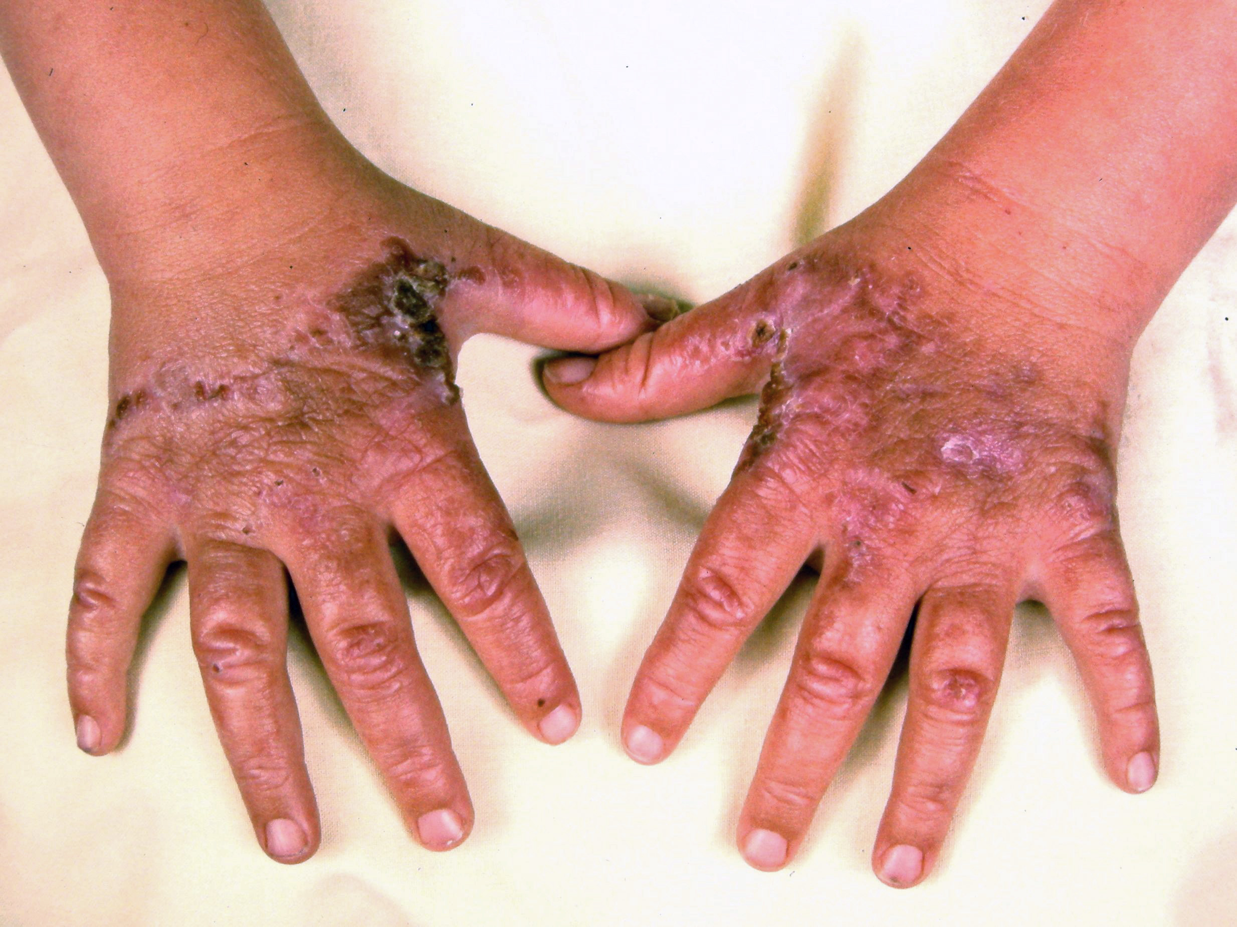 <p>Acute sunburn reaction in young child with erythropoeitic protoporphyria</p>