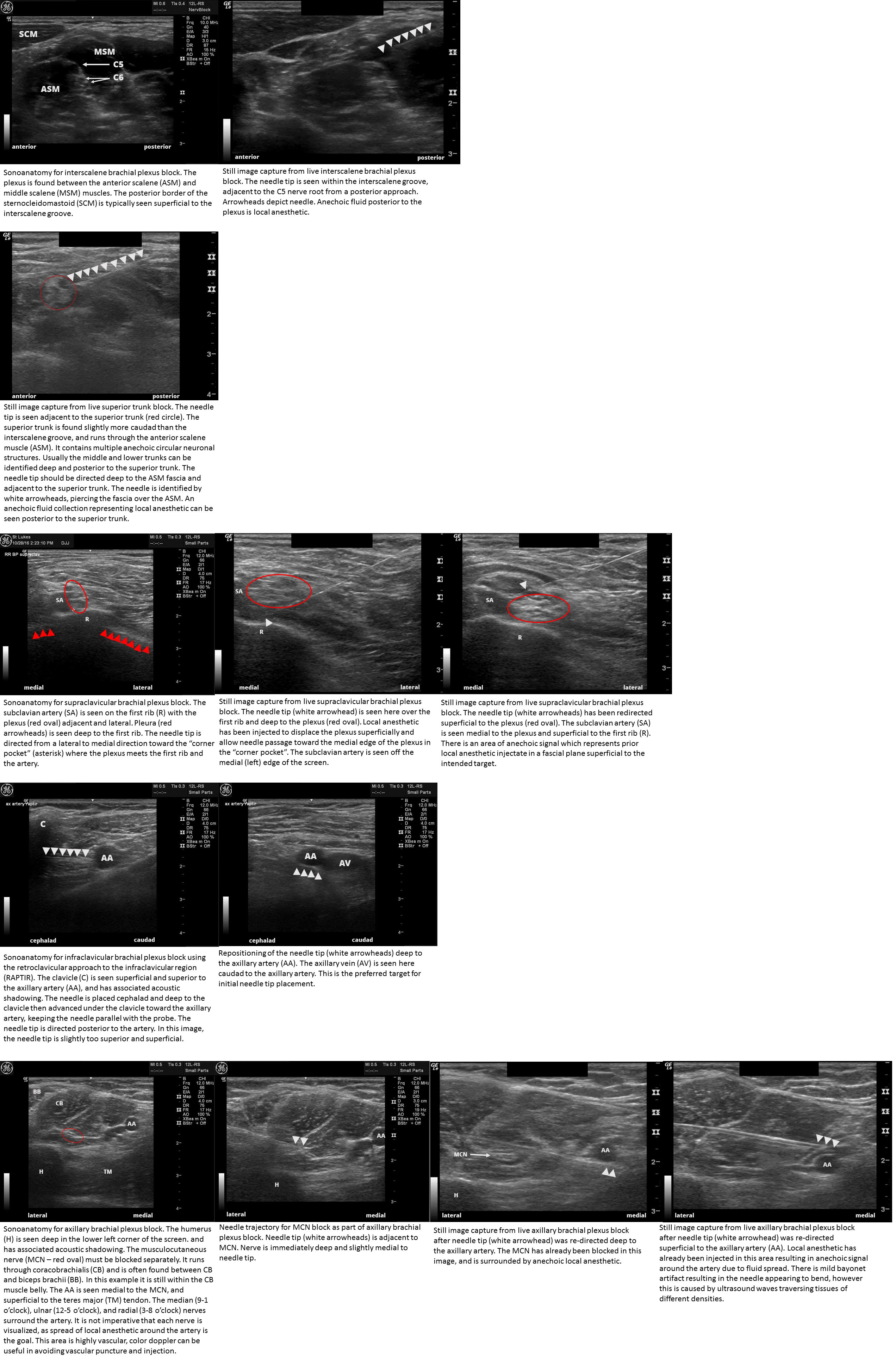 Sonoanatomy and needle placement for ultrasound guided brachial plexus blocks Includes interscalene brachial plexus block, su