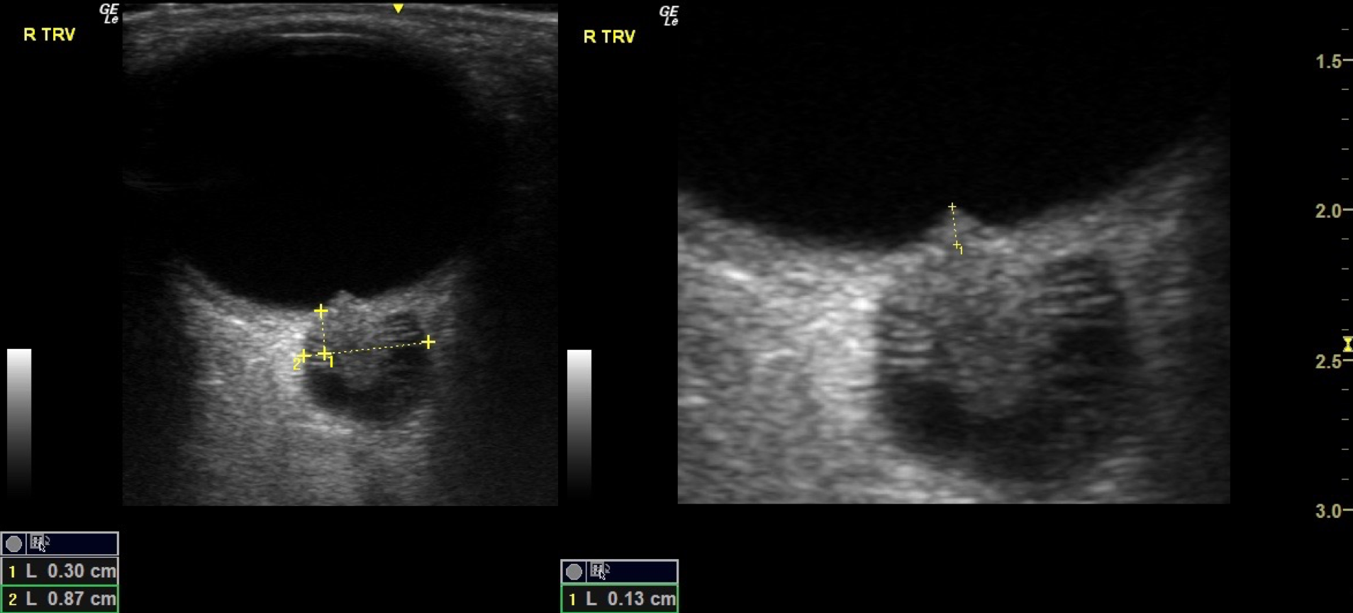 Widened optic nerve sheath and papilledema (ultrasound image)
