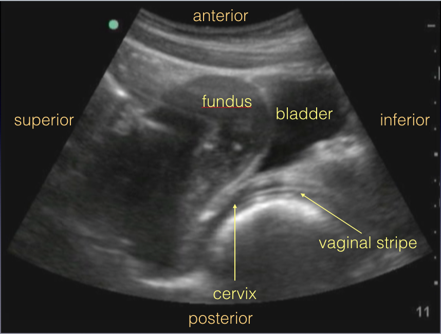 Sagittal transabdominal pelvis view