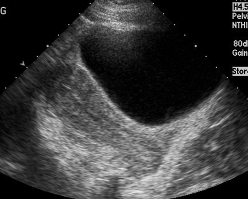 TA long image of a normal uterus