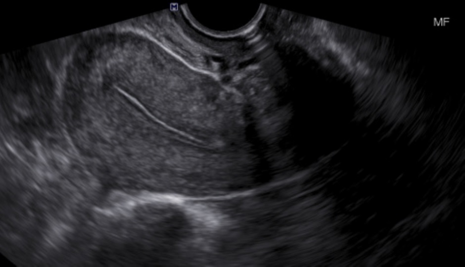 <p>Transvaginal&nbsp;Long Image of a Normal Uterus. Note the bladder is not fluid-filled nor readily visible</p>