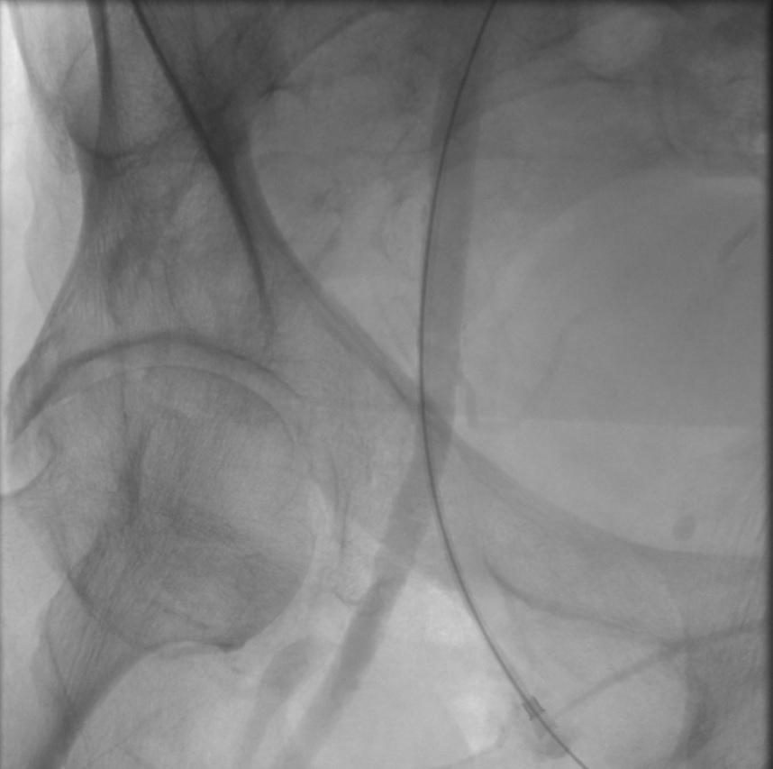 Access into Right Common Femoral Artery using micropuncture system during transfemoral carotid artery stenting