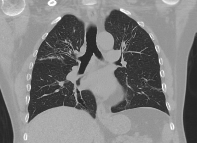 <p>Allergic Bronchopulmonary Aspergillosis on Computed Tomography