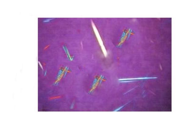 <p>Uric Acid Crystals, Birefringent on Polarized Light