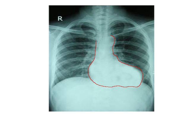 <p>Chest X-ray of Tetralogy of Fallot</p>