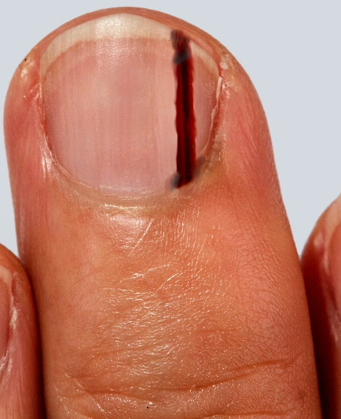 subungual melanoma of the middle finger