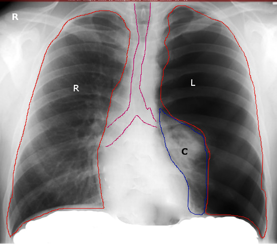 <p>Left Tension Pneumothorax Radiograph