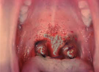 <p>Diphtheria in the Oral Cavity