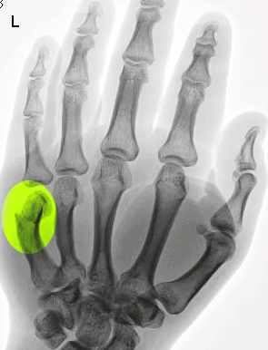 <p>Boxer's Fracture.&nbsp;This x-ray shows a left 5th metacarpal fracture (marked yellow-green).</p>