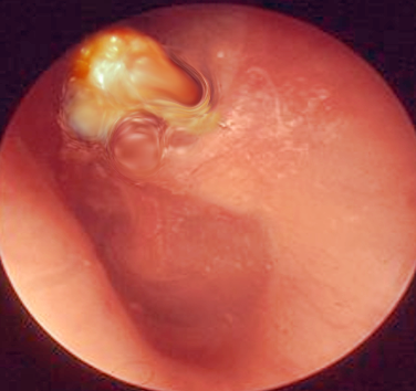 Cholesteatoma of the right ear