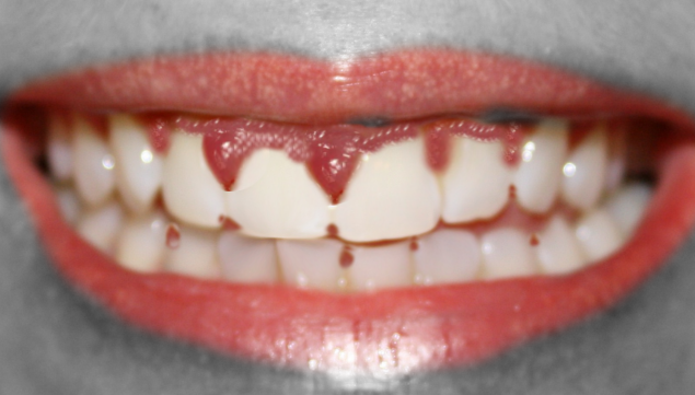 <p>Gingival Overgrowth From a Medication</p>