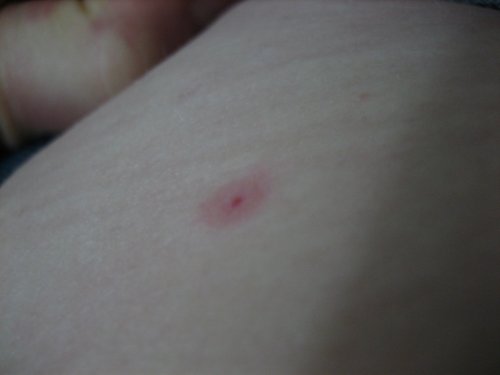 <p>Flea Bite.&nbsp;A&nbsp;flea bite with&nbsp;a hemorrhagic center and surrounding erythema are present.</p>