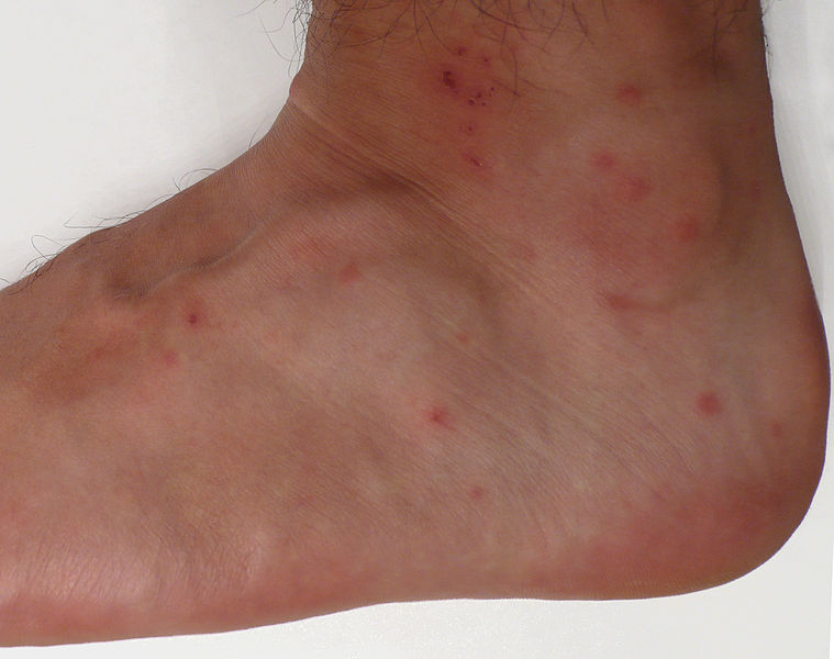 <p>Chigger Bites. Dermatological manifestations from multiple chigger bites.</p>