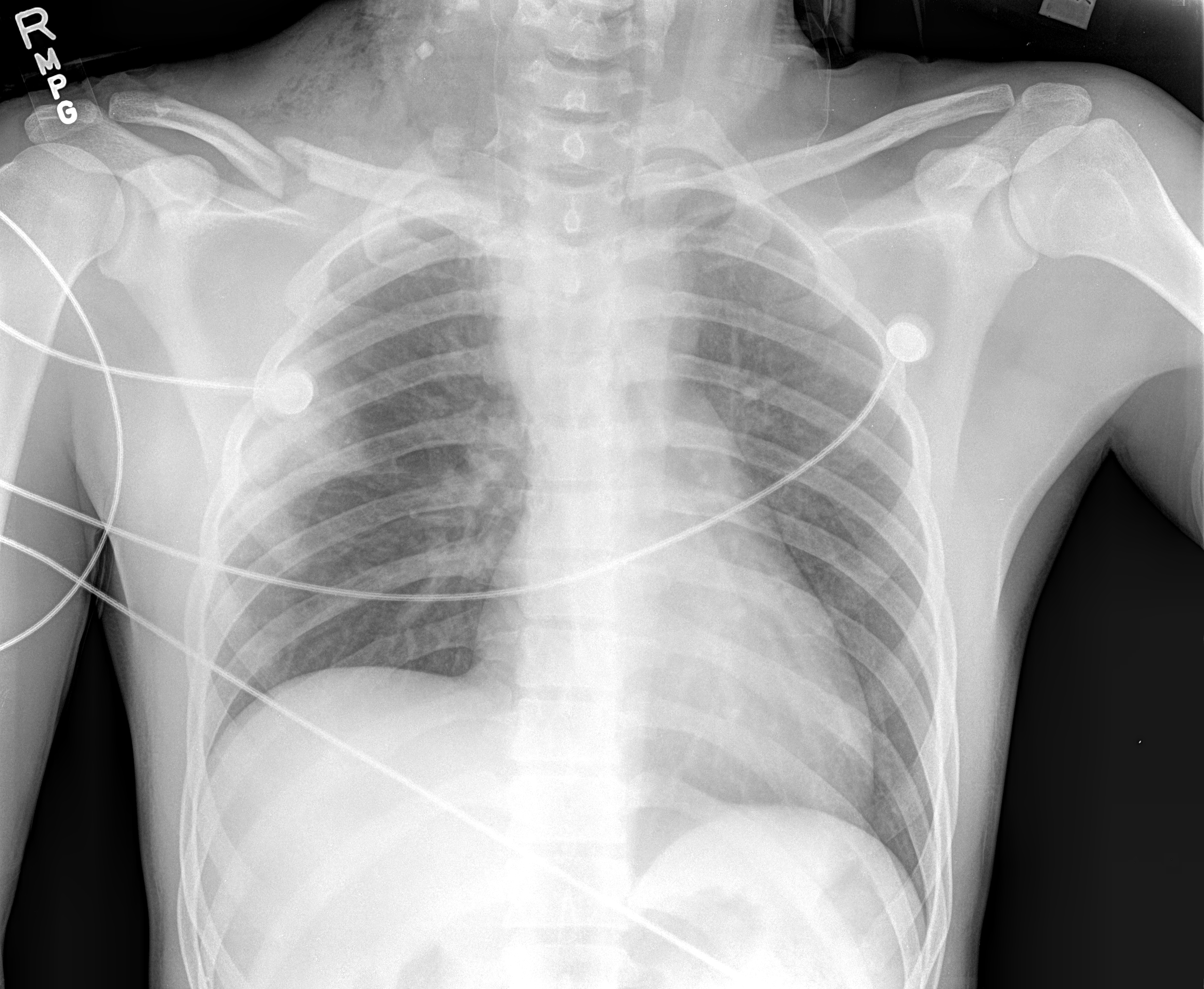 Chest x-ray of a patient who sustained traumatic root avulsion brachial plexus injury
