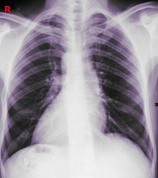 <p>Dextrocardia Chest X-ray</p>