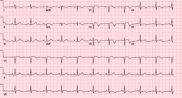 ECG demonstrating the second type of pattern associated with Wellens’ syndrome