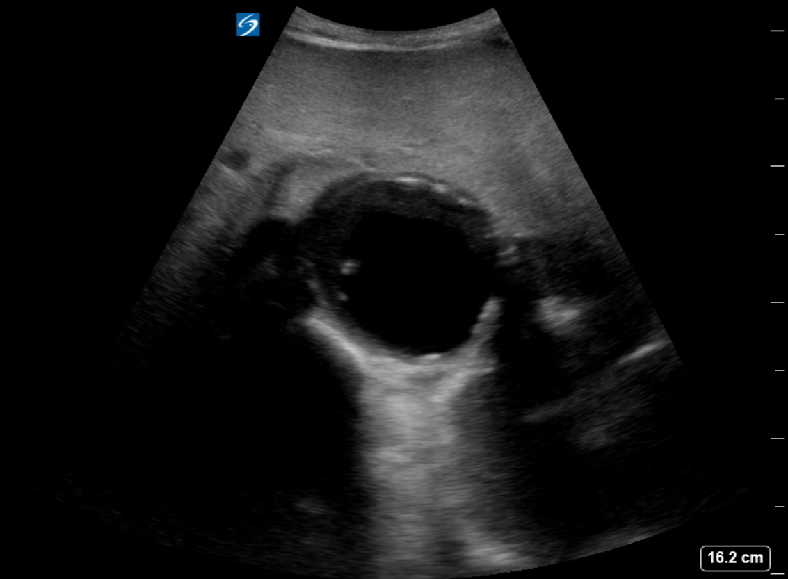 <p>Ultrasound of Abdominal Aortic Aneurysm. Abdominal aortic aneurysm as visualized on ultrasound.</p>