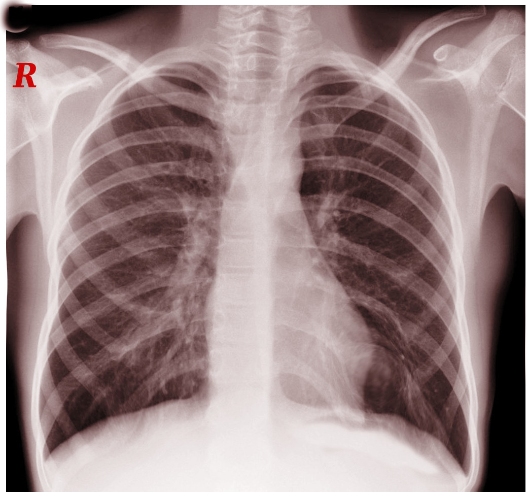 cervical rib on chest x-ray
