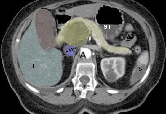 <p>Pancreatic Cancer, Courvoisier Sign