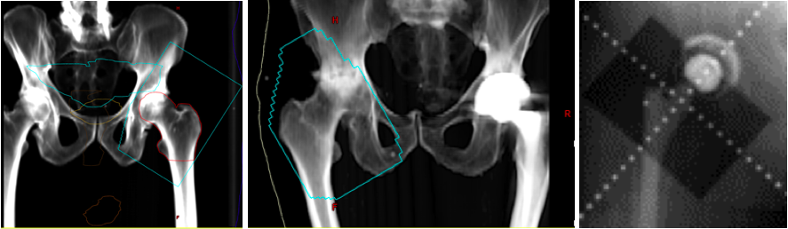 <p>Heterotopic Ossification of the Hip