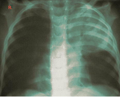 post op atelectasis chest x-ray