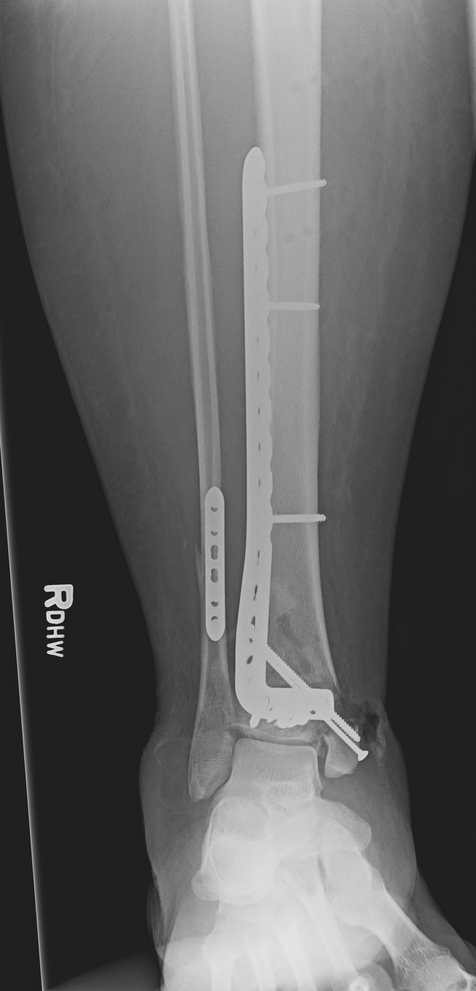 Postoperative AP x-ray shows placement of an anterolateral distal tibia plate with anatomic reduction of the distal tibial and fibular fractures and a congruent mortise