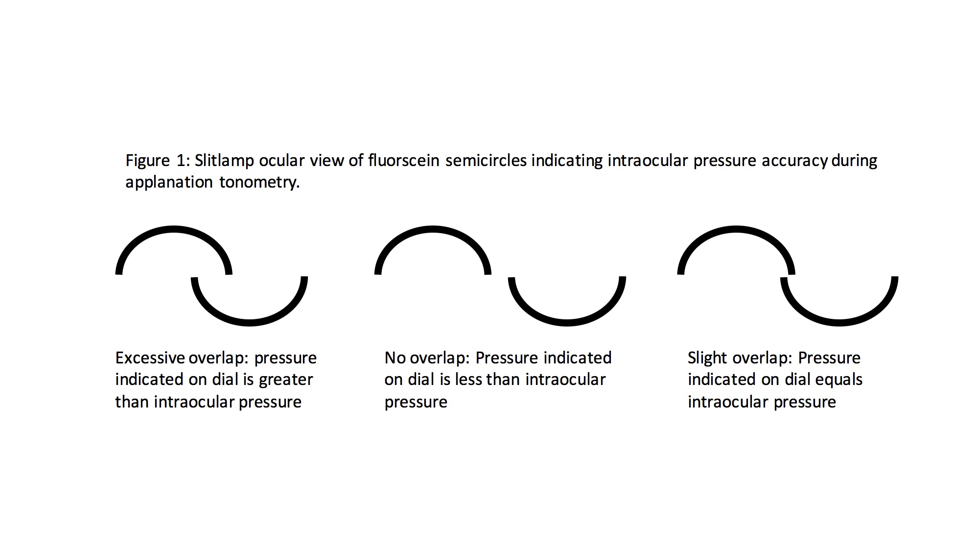 Fluorescein semicircles during Goldman Applanation Tonometery (GAT) to measure intraocular pressure (IOP)