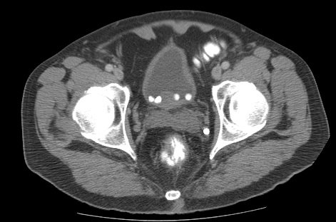 CT of pelvis showing multiple bladder stones in 65 year old male with benign prostatic hyperplasia.