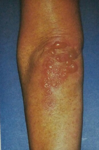 Dermatitis herpetiformis. Intact tense bullae on the elbow.