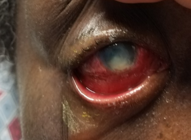 Fungal Keratitis. Gross torch light assessment shows fungal keratitis with injection, chemosis, and hypopyon.