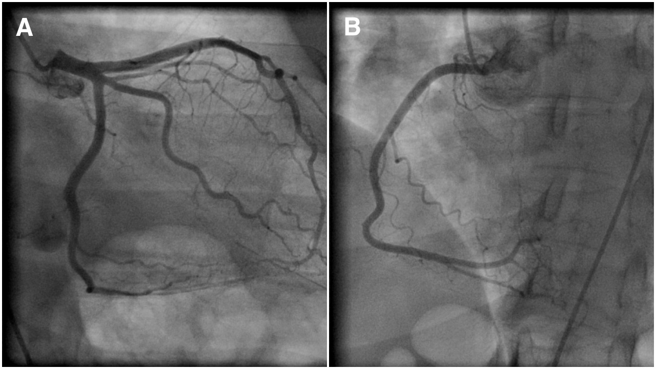<p>Coronary Angiogram Showing Normal Epicardial Left (A) and Right (B) Coronary Arteries.</p>