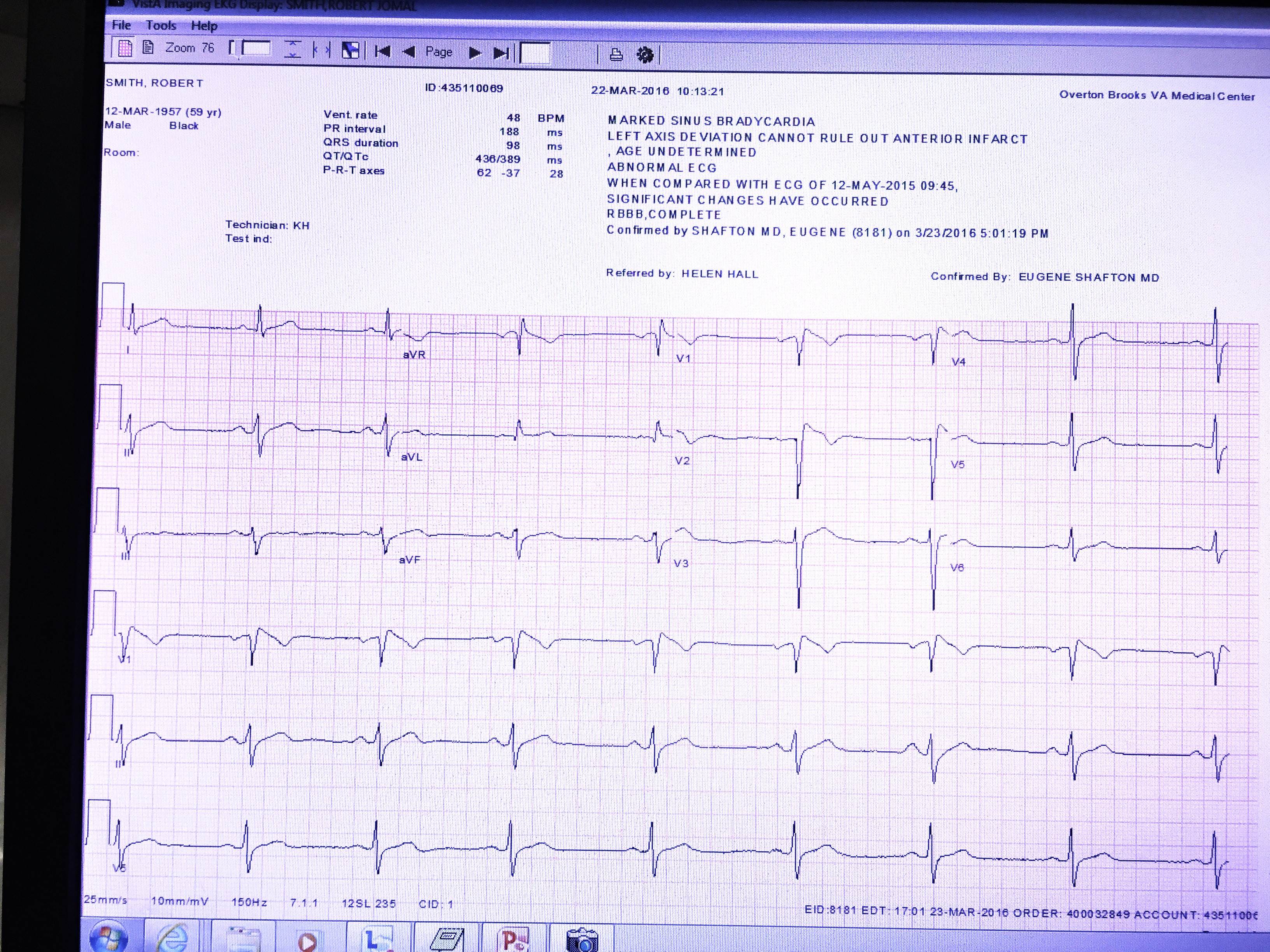 Electrocardiogram of patient with syncope.