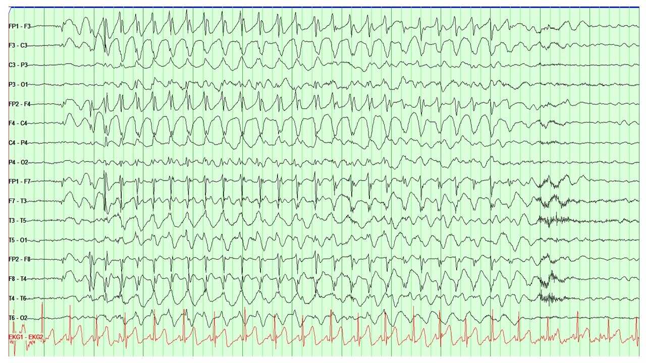 EEG showing the characteristic 3Hz spike and wave discharges seen in absence epilepsy