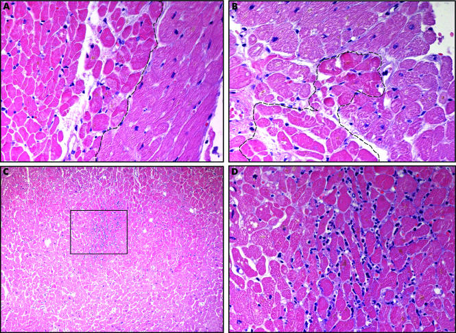 <p>Coagulative Necrosis in Myocytes During Silent Myocardial Ischemia
