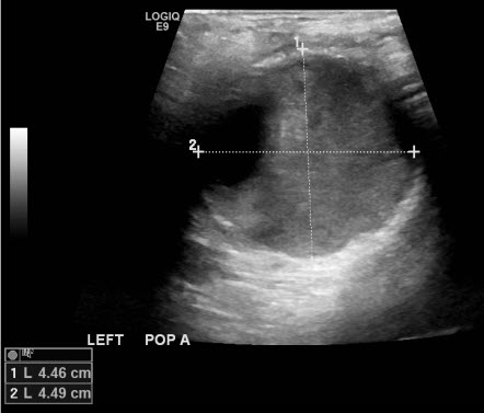 <p>Ultrasound of Left Popliteal Artery Aneurysm. Ultrasound imaging visualizes a left popliteal artery aneurysm.</p>