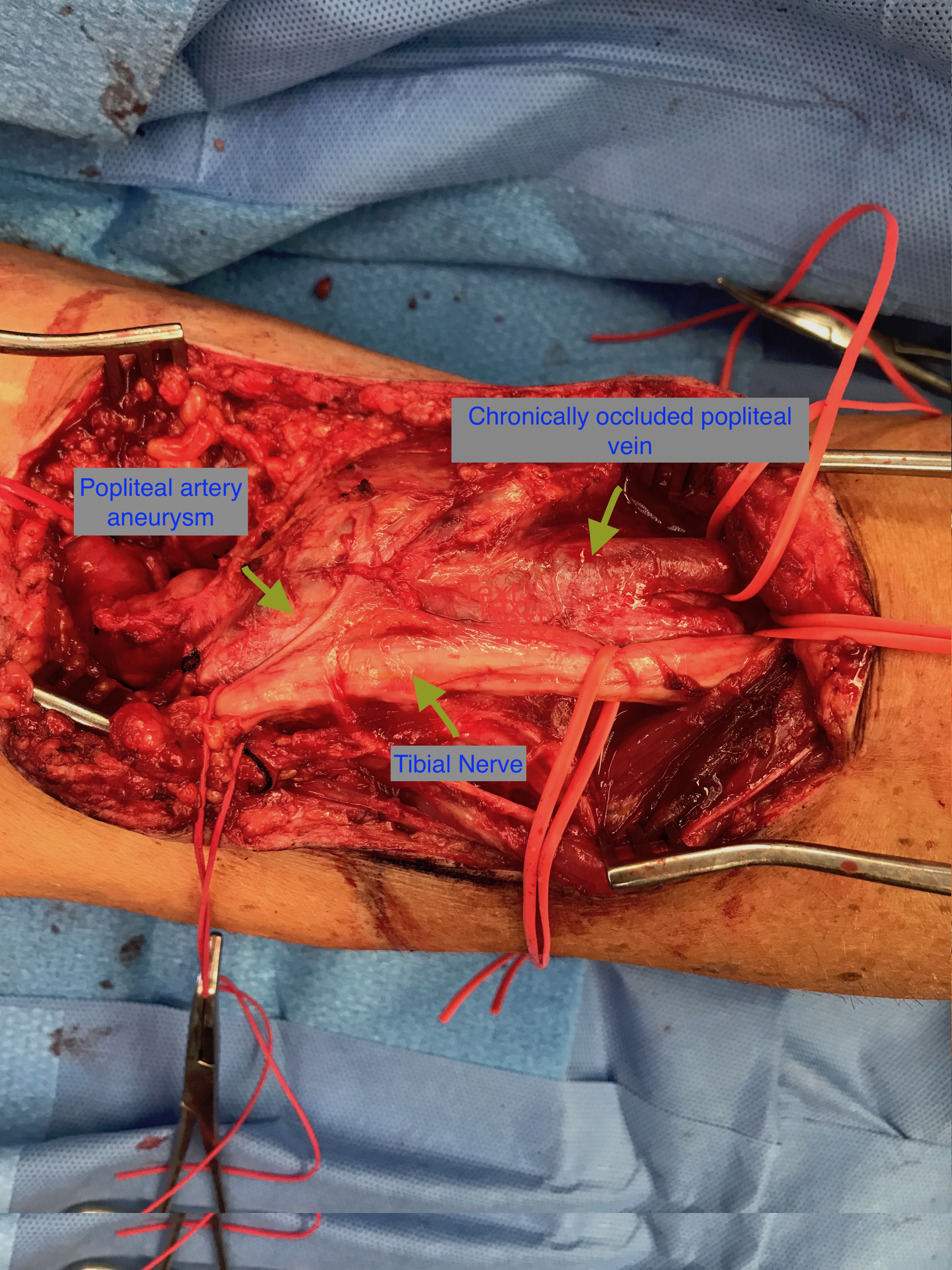 <p>Intraoperative Popliteal Artery Aneurysm Repair