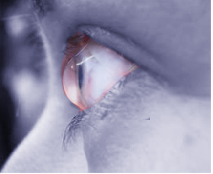 <p>Keratoconus. This image shows&nbsp;corneal steepening that is characteristic&nbsp;of keratoconus.</p>