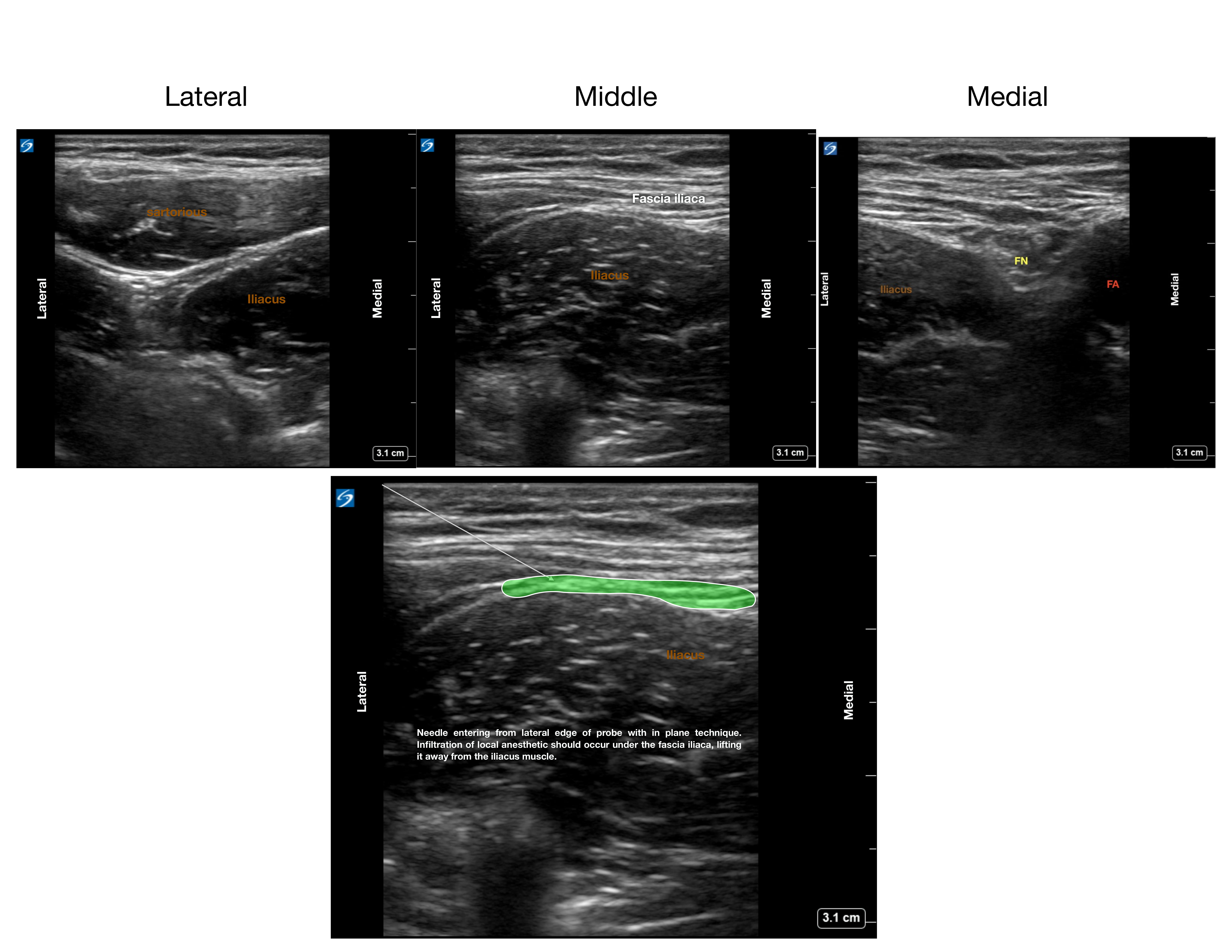 Anatomy of the fascia iliaca and ideal needle positioning